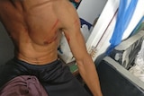 A refugee on Manus Island, who says his injuries were caused by police.