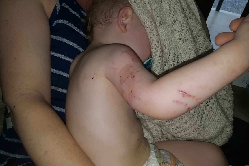 Toddler Naish Dobson's arm and torso after he was bitten by a large scrub python at Julatten, Queensland.