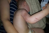 22-month-old Naish Dobson suffered two bites to his forearm and one on his upper arm.