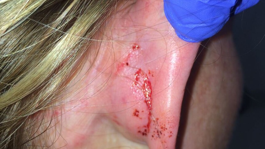 A closeup of Kim Proudlove's ear injury.