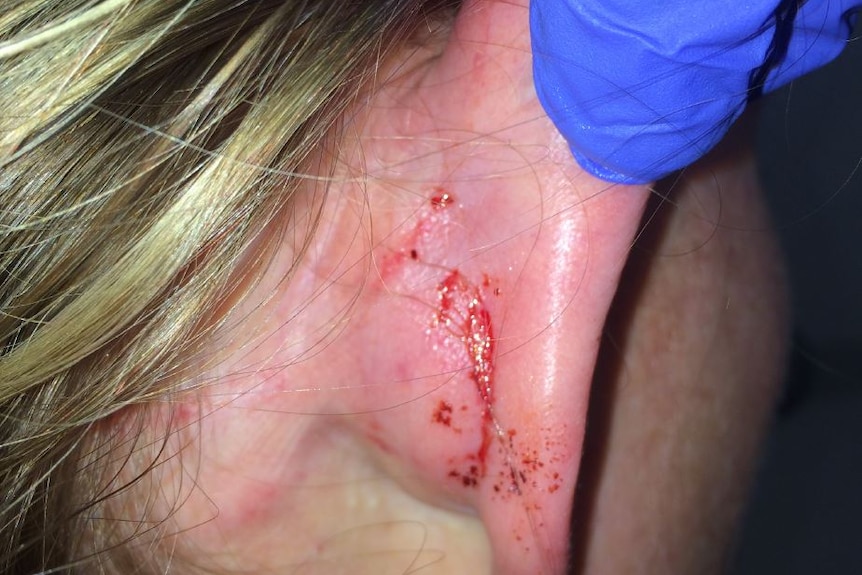 A closeup of Kim Proudlove's ear injury.