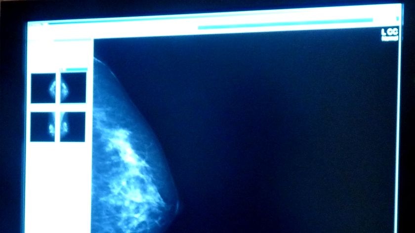 Image captured by breast scan machine
