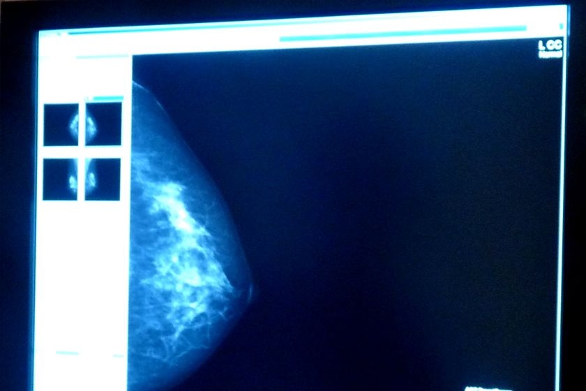 Image captured by breast scan machine.