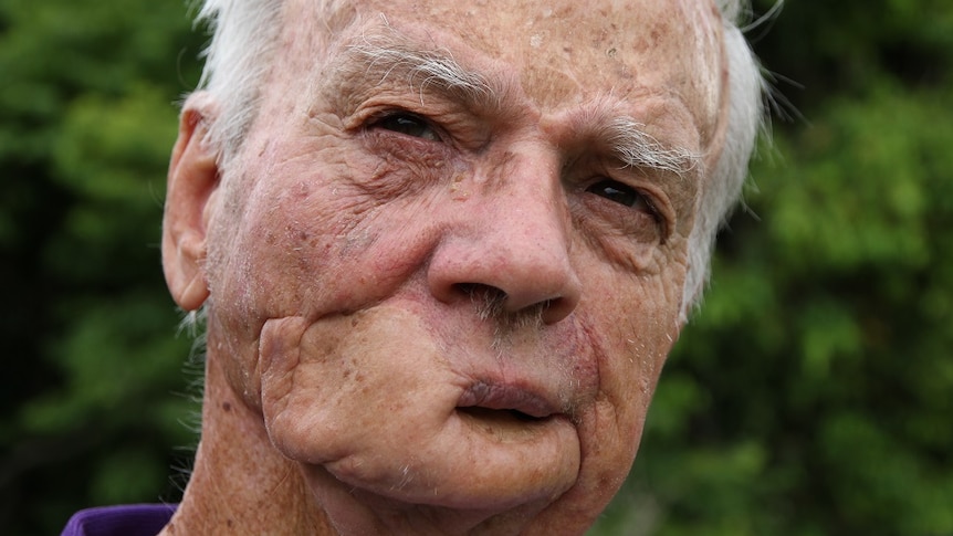 A man's face with a disfigured jaw