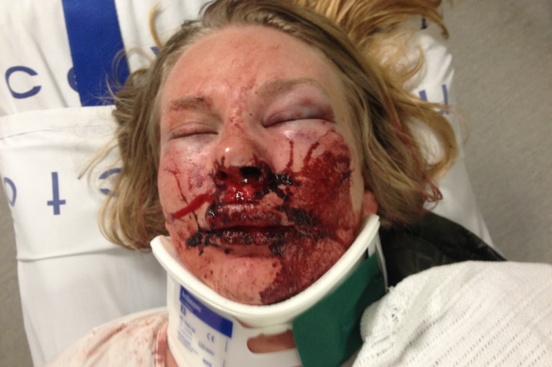 A woman is seen in a hospital bed with blood all over her face, which is swollen.