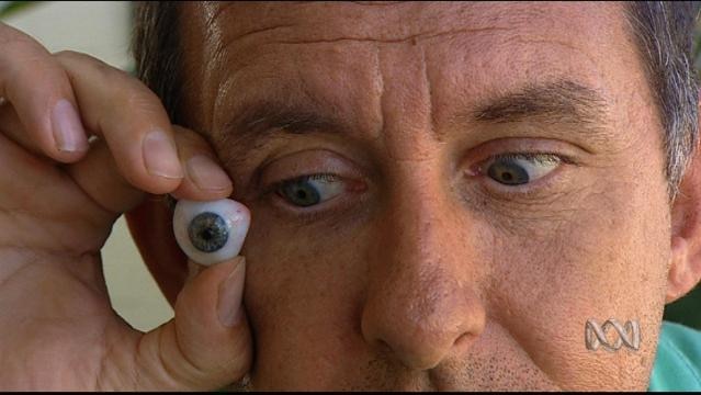 A man holds a prosthetic eyeball
