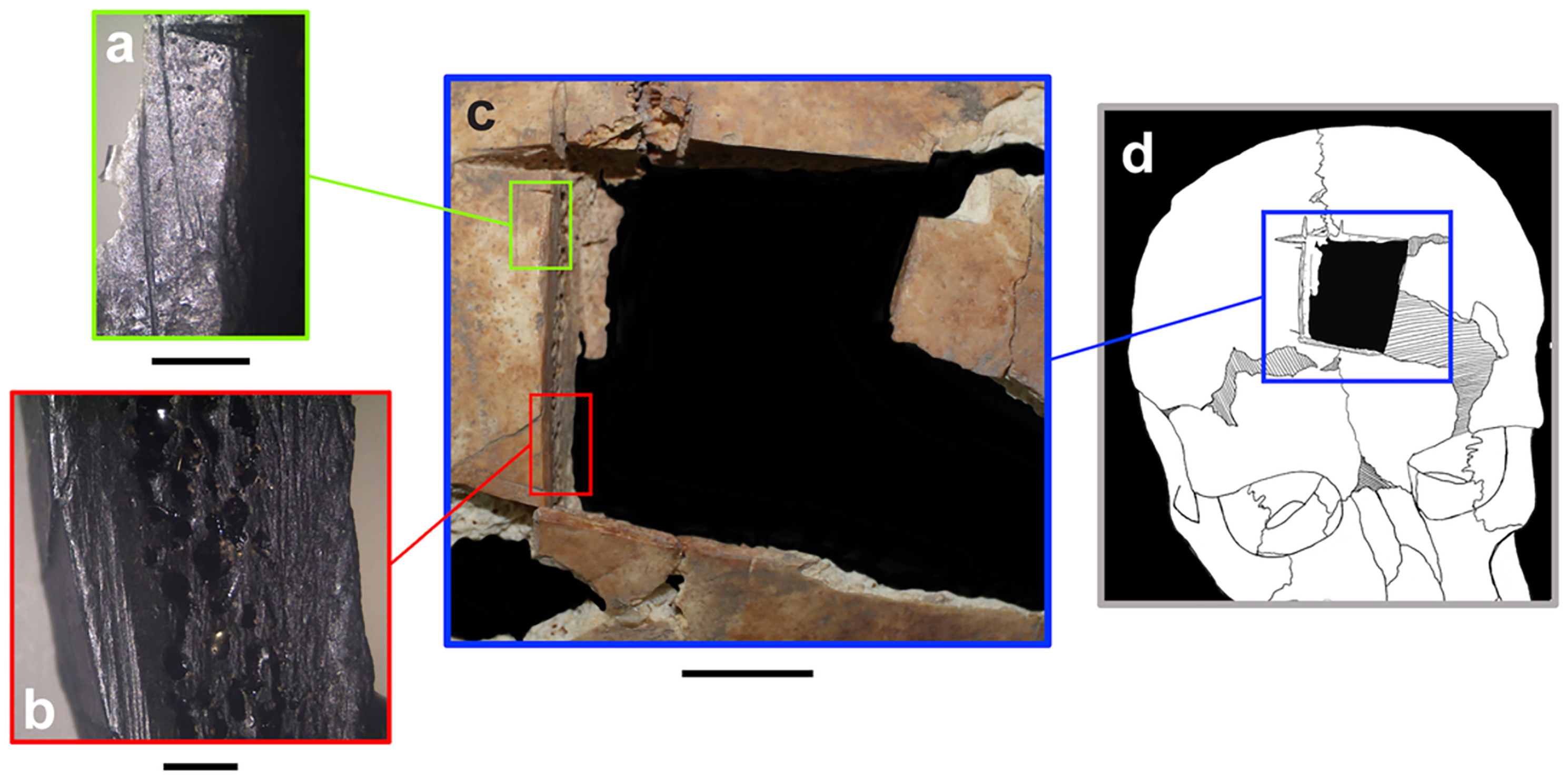 Series of images show a skull bone with a square missing, an illustration showing where the trephination is located in the skull