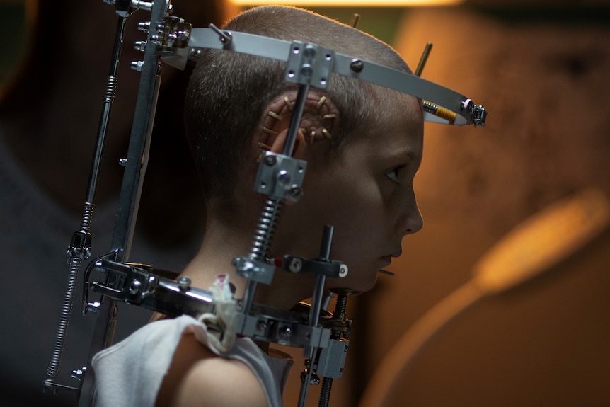 A young girl with shaved head in an elaborate metal device that surrounds her skull and neck