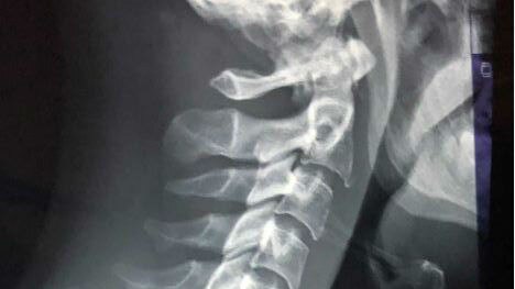 X-ray of man's neck