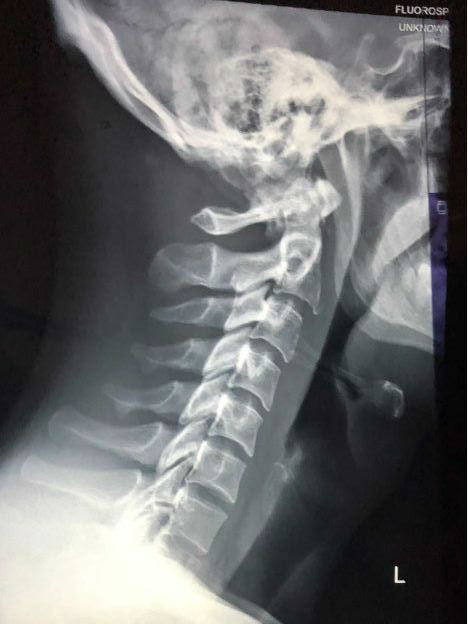 X-ray of man's neck