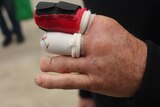 A close up picture of his hand, with one finger bandaged, one in a cast and one shorter than it should be