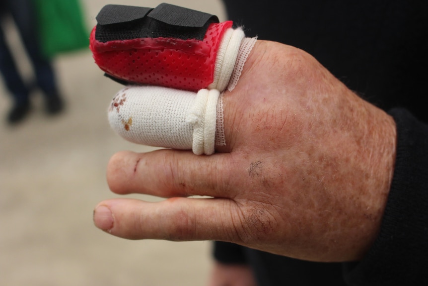 A close up picture of his hand, with one finger bandaged, one in a cast and one shorter than it should be