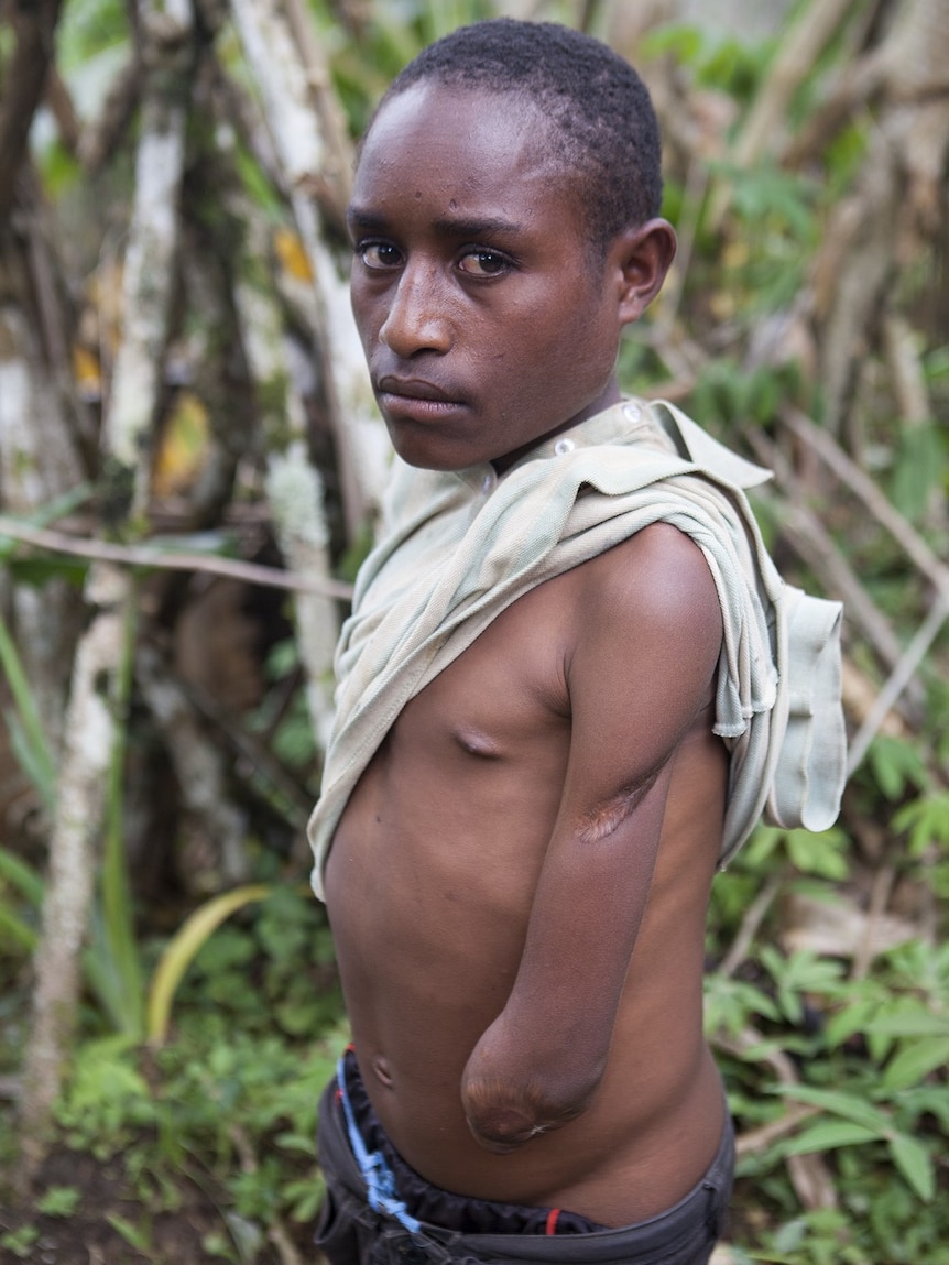 Robert Lepo, 11, shows his arm amputated from the elbow down. He was attacked with machetes during a 2013 tribal war in PNG.