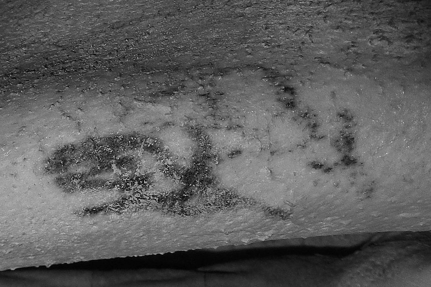 A black and white image showing faint dark markings on skin.