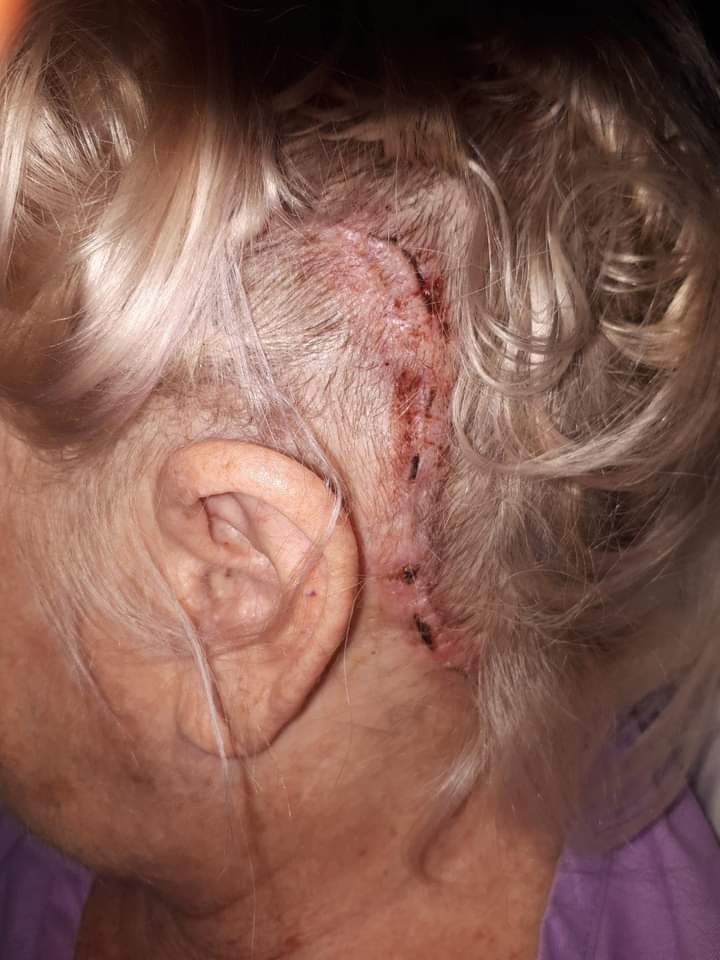 Long wound with stiches in the head of a blond-haired woman. 