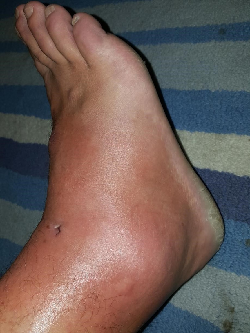 A close-up of a man's swollen foot lying on a blanket with a puncture wound above his ankle.