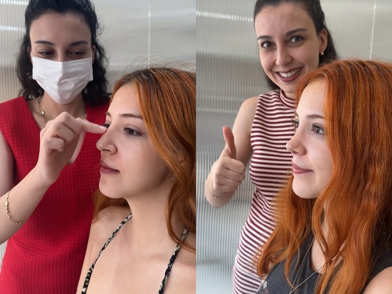 Um cirurgião mostra um exemplo de antes e depois do "nariz de barbie" no TikTok.