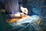 The surgeon performs open heart surgery