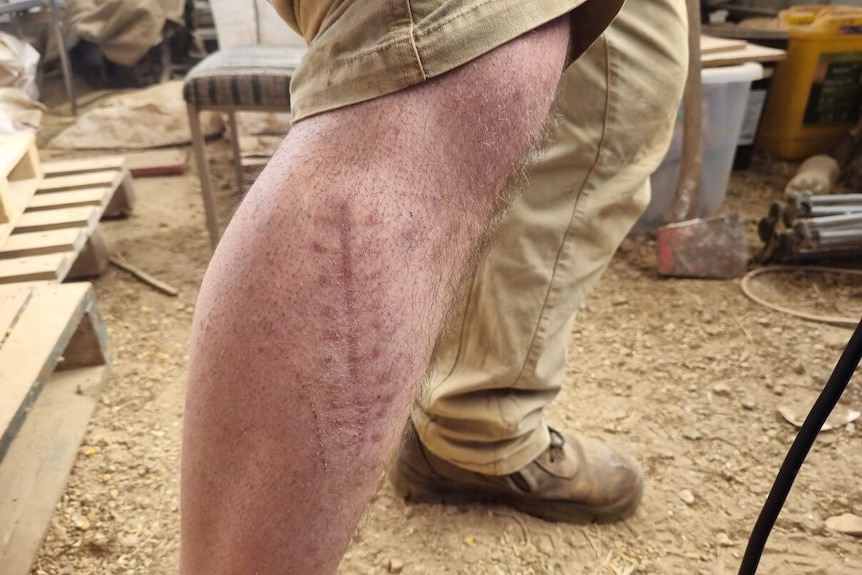 A hairy male leg with a giant healed gash in it's side.