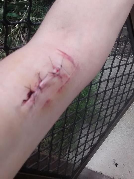 This woman experienced severe scarring and required stitches after the removal of an Implanon.