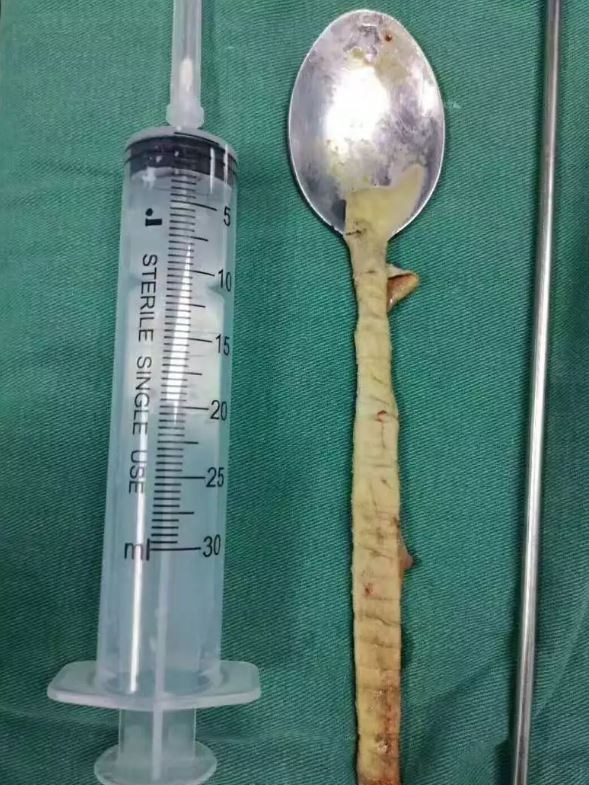 A grimy spoon covered in a film of mucous placed next to a syringe for scale. The spoon is roughly 20cm long.