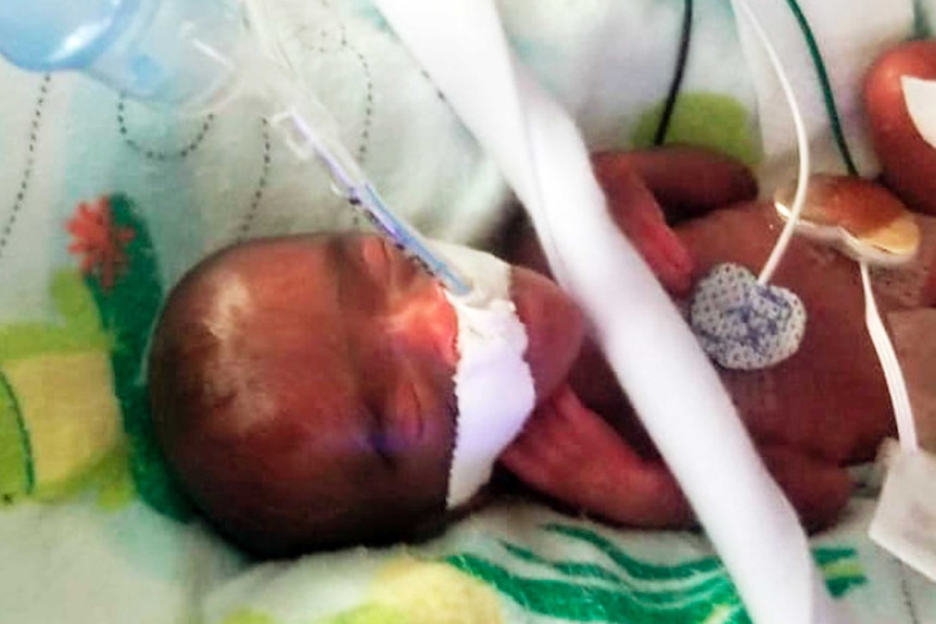 A premature baby lies in a cot with tubes attached to her