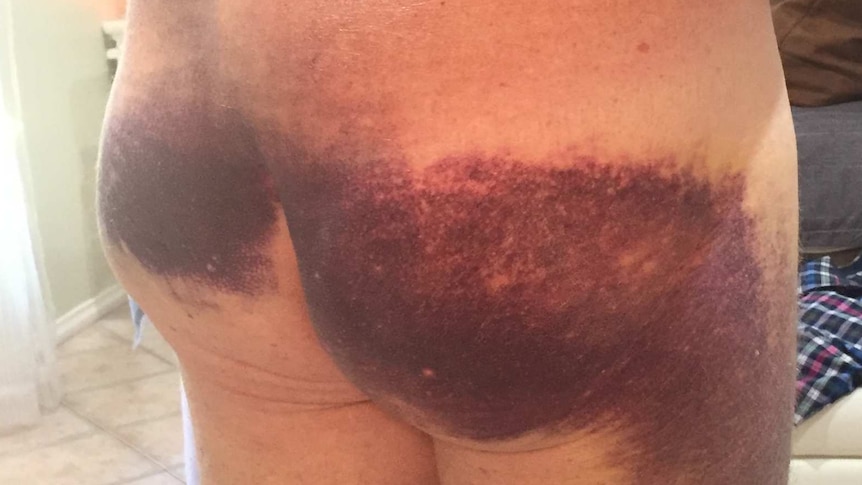 A man's bottom very badly bruised from a fall off a horse