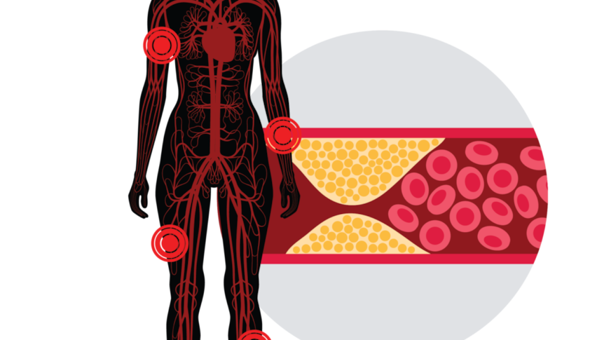 Fat, cholesterol and other substances build up in the walls of the arteries, restricting blood flow.