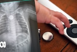 X ray shows button battery in a childs throat. 