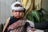 A young Syrian girl with bandages covering much of her scalp, one eye is swollen shut, cuts on her face, blood on her face