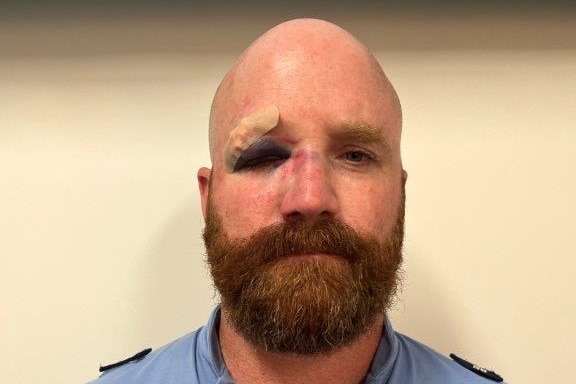A police officer with a bandage over the top of a black and bruised eye