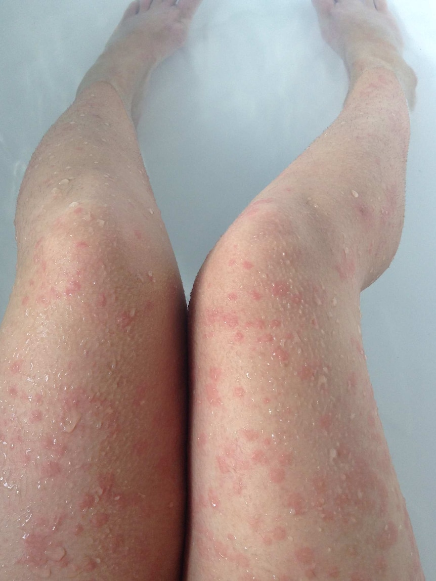 A womans legs covered in big red marks.