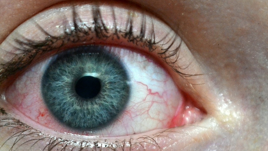 A close up of a woman's blood-shot eyeball