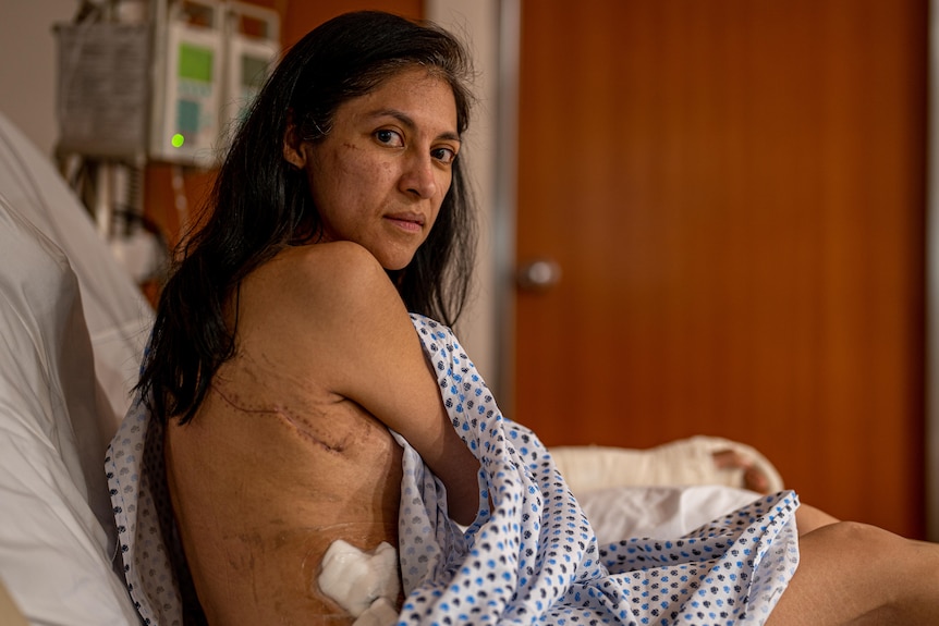 A woman with scars on her back.