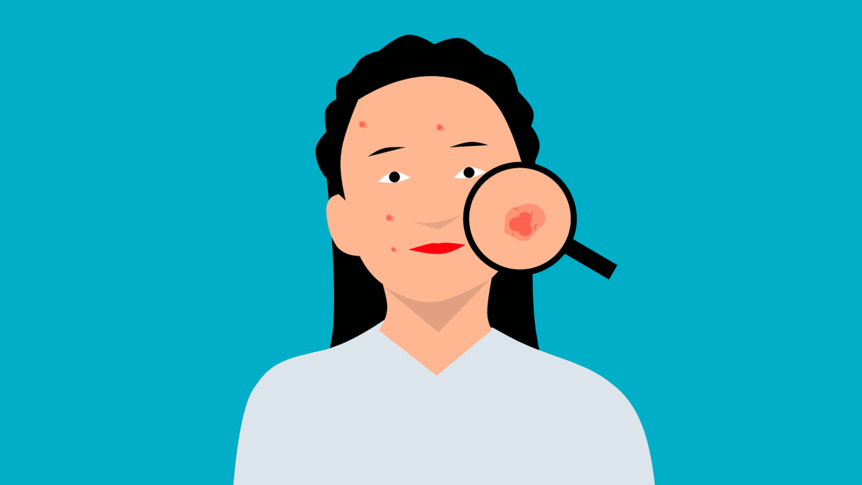 An illustration of a woman with acne with a magnifying glass over one of the spots.