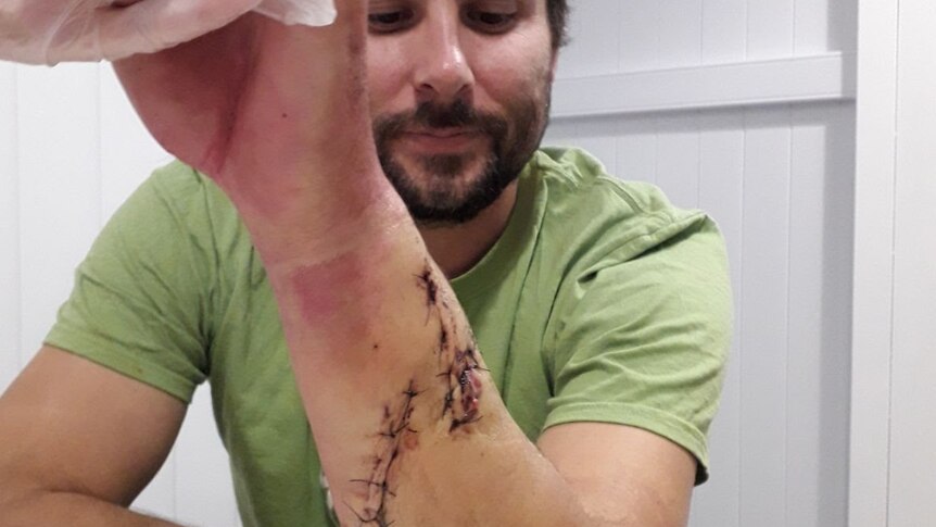 Mathew Vickers shows his shark bite wound