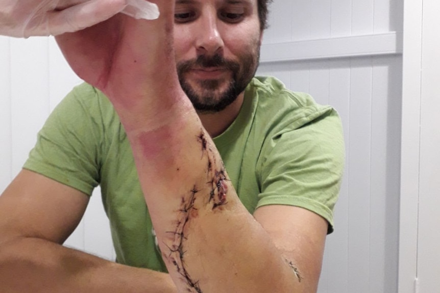 Mathew Vickers shows his shark bite wound