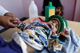 A girl is being treated at a malnutrition treatment centre in Sanaa, Yemen.