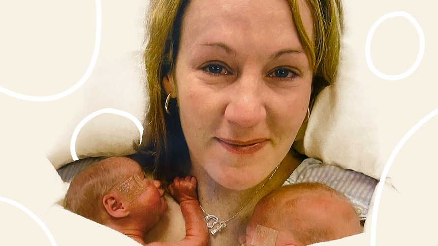 Close up of a woman with two premature babies on her chest for a story on bringing home a premature baby. 