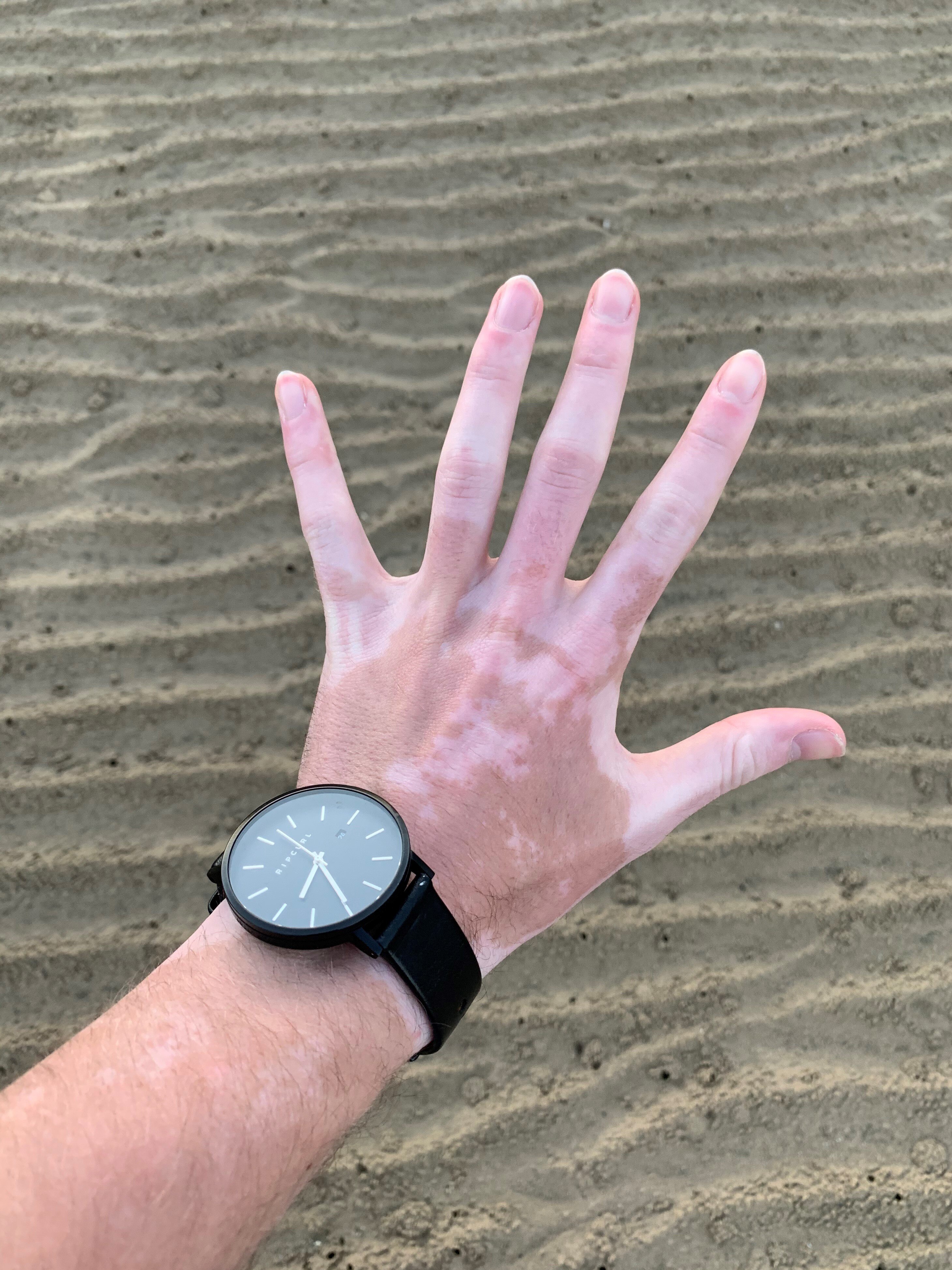 A hand with lighter patches on the skin, held out in front of sand.