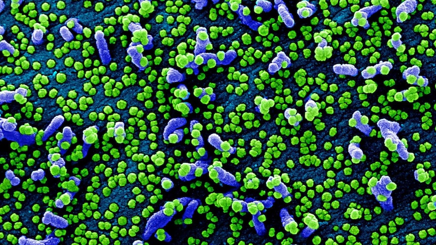 Hundreds of green spheres cluster together on what look like strange purple worms - an electron microscope image of SARS-CoV-2