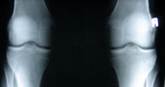 X-Ray of knees