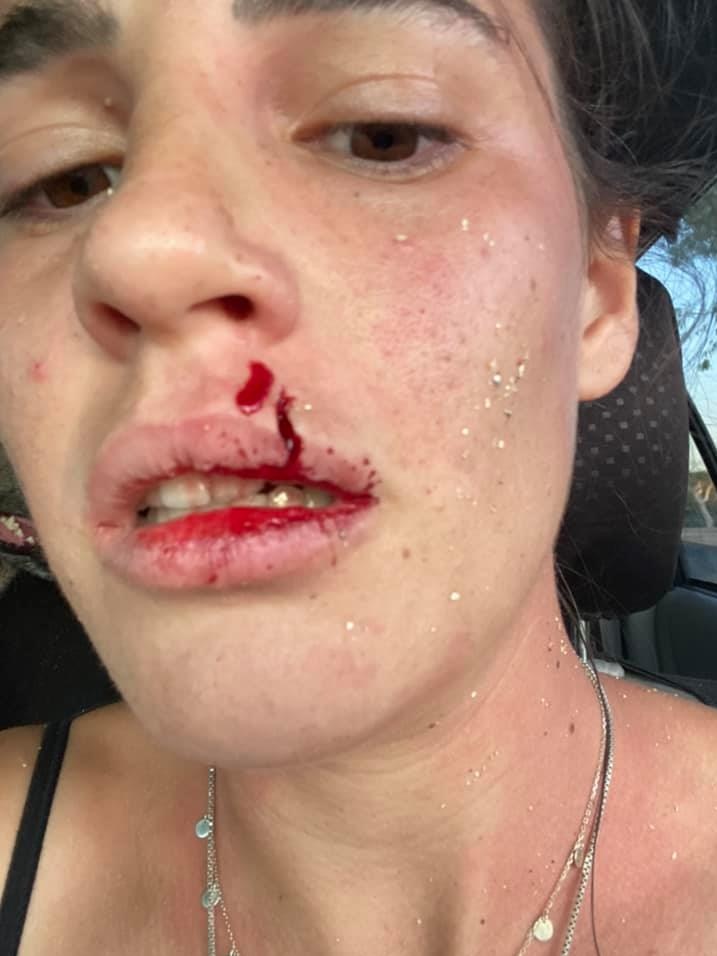 Asha Haegel is pictured with a cut to her face - above her lip - after she attempted to save her dog from a wild dog attack.