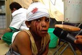 Child with bandage wrapped around his head and blood on his face