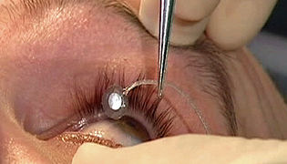 Bionic eye testing moves into the field - ABC News