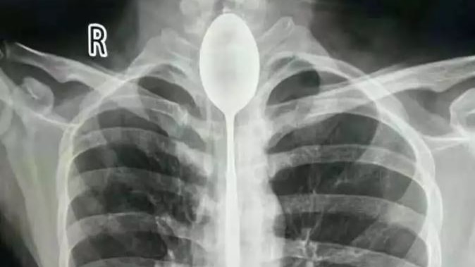 An X-ray image shows a 20cm long spoon lodged in a man's oesophagus.
