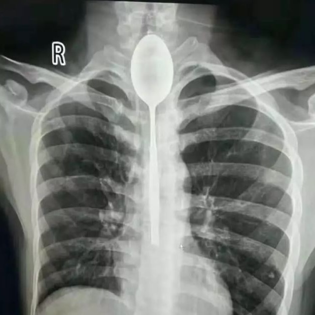 An X-ray image shows a 20cm long spoon lodged in a man's oesophagus.