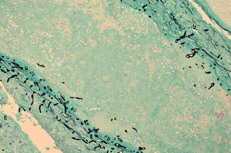 Blue photomicrograph shows fungal infection of brain tissue from patients with clinical cases of meningitis.