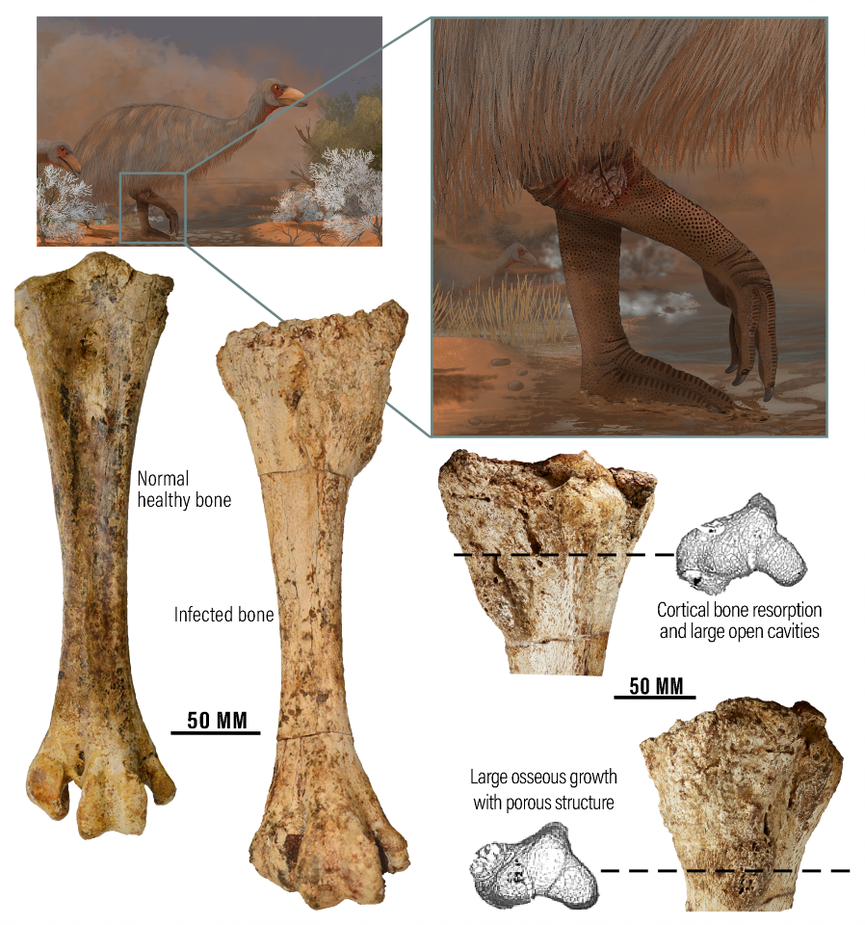 Fossil discovery shows some Australian 'thunder birds' had painful bone  infection before species went extinct - ABC News