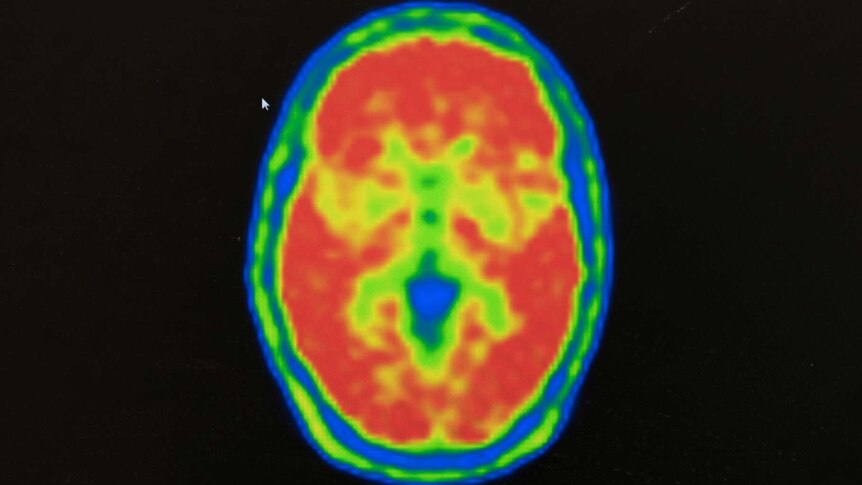 The red zones of Karen Cooke's brain indicate the Amyloid build up.